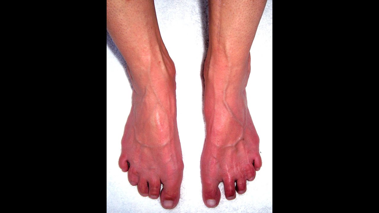 Erythromelalgia Research Insights