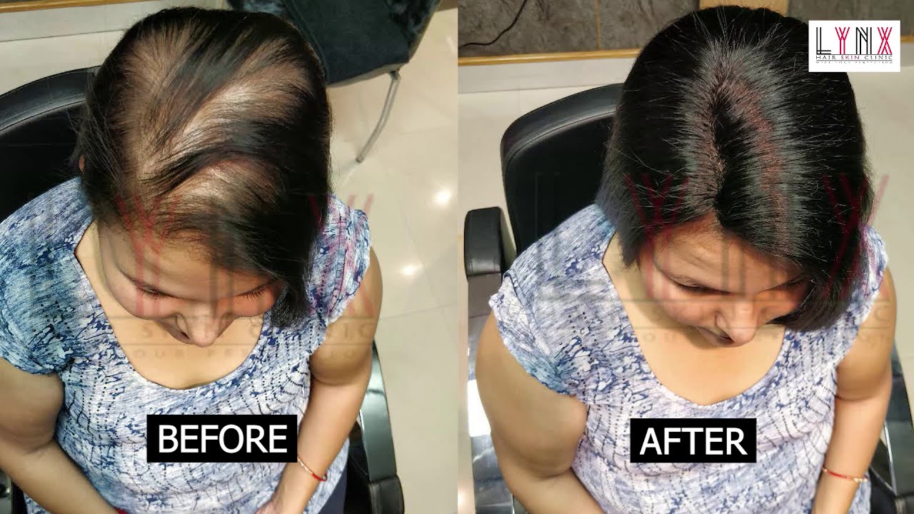 Ladies Hair Patch Center in Delhi | Ladies Hair Topper for Women | Hair Topper for Very Thin Hair
