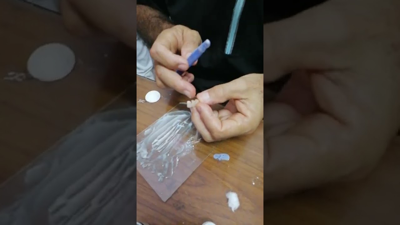 Cementacion con ionómero de vidrio