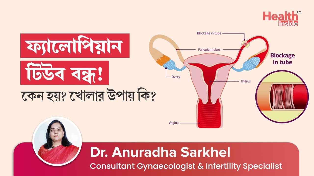 Fallopian Tube Blockage: Causes, Types & Treatment | How to open blocked fallopian tube?