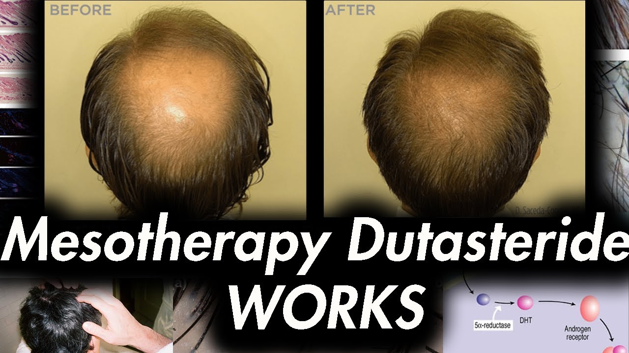 Mesotherapy Dutasteride: What to expect? Hair loss reversal....
