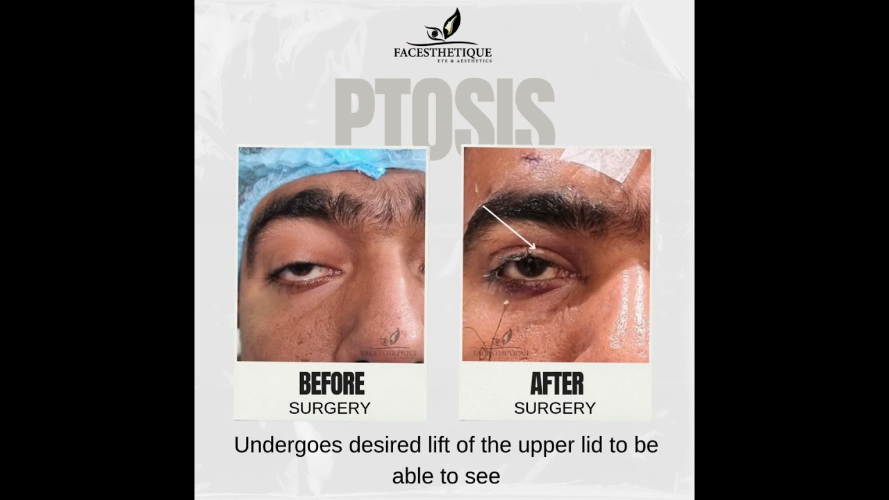 CPEO - Frontalis Silicone Sling Surgery by Dr. Shilpa Taneja Mittal