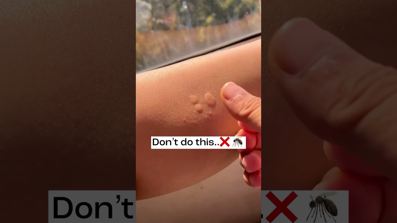 Mosquito bite 5 minutes solution 😍 🦟  no more itchiness or black spots