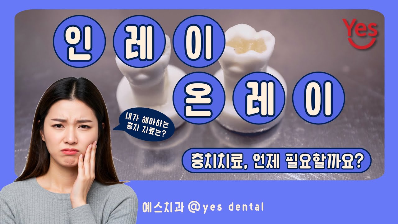 충치치료 인레이와 온레이, 언제 필요할까요?