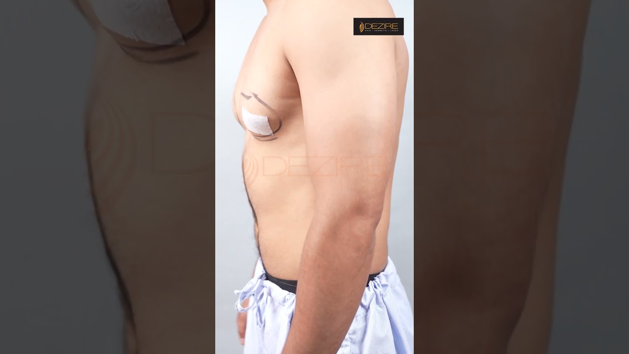 Gynecomastia result