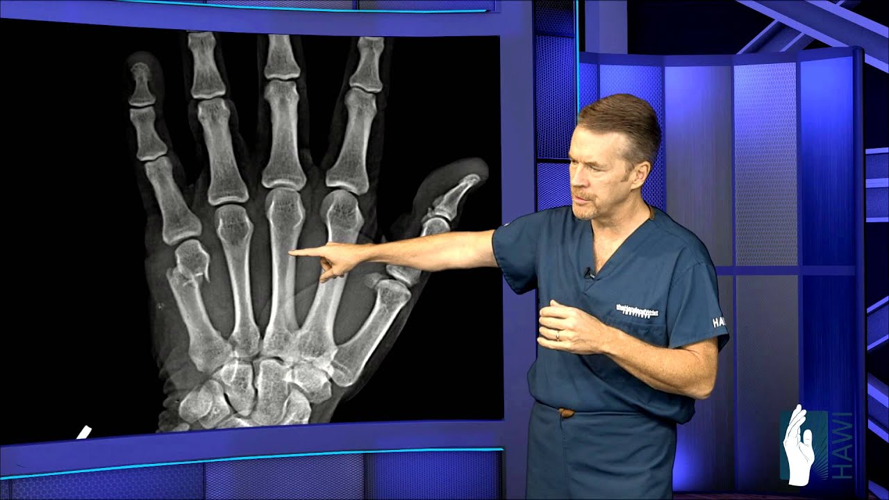 Hand Fracture Surgery