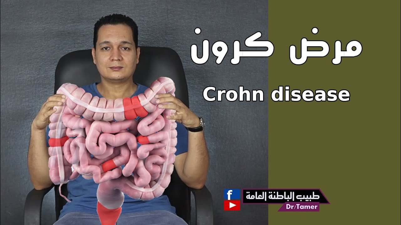 مرض كرون / Crohn disease