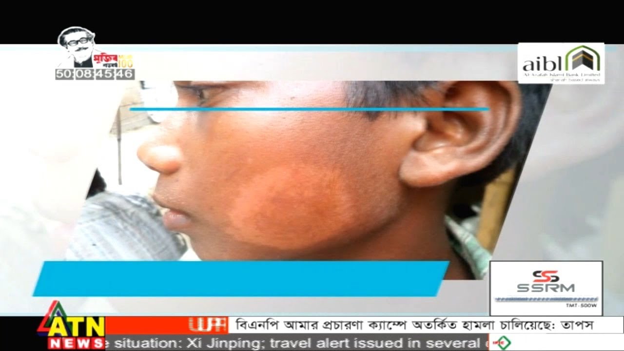 সময়মত চিকিৎসা না পেয়ে প্রতি ৪ হাজার কুষ্ঠ রোগীর মধ্যে ৪শ জনই হয়ে পড়েন বিকলাঙ্গ