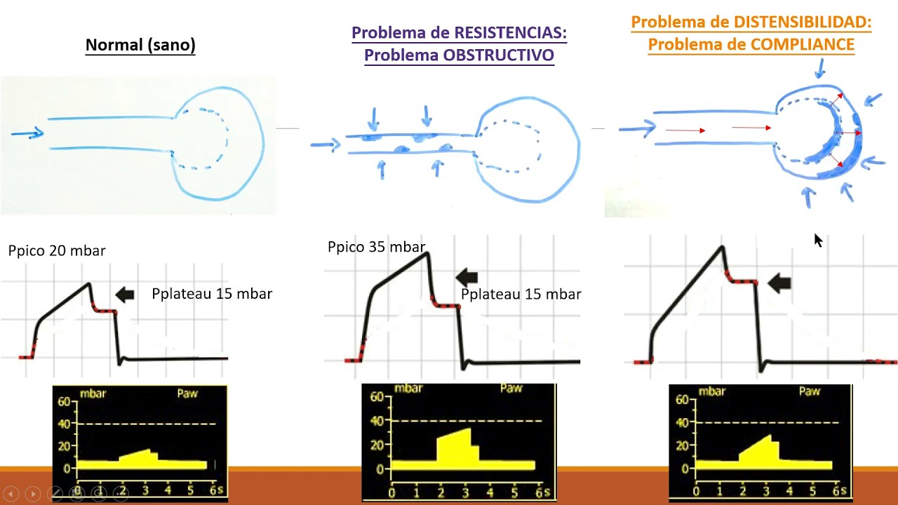 Gráfica presión/tiempo en ventilación controlada por volumen (Oxylog 3000 plus)