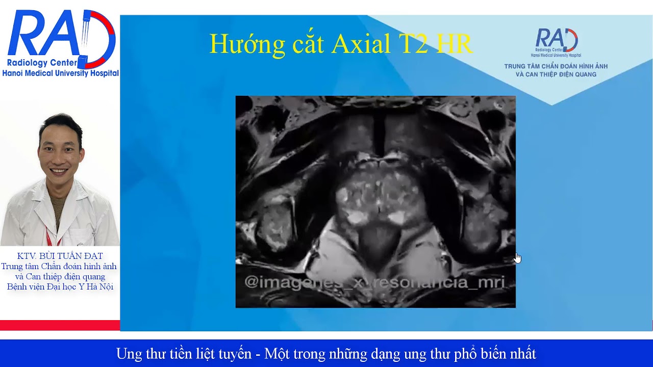 Kỹ thuật chụp cộng hưởng từ tiền liệt tuyến: Những lưu ý quan trọng
