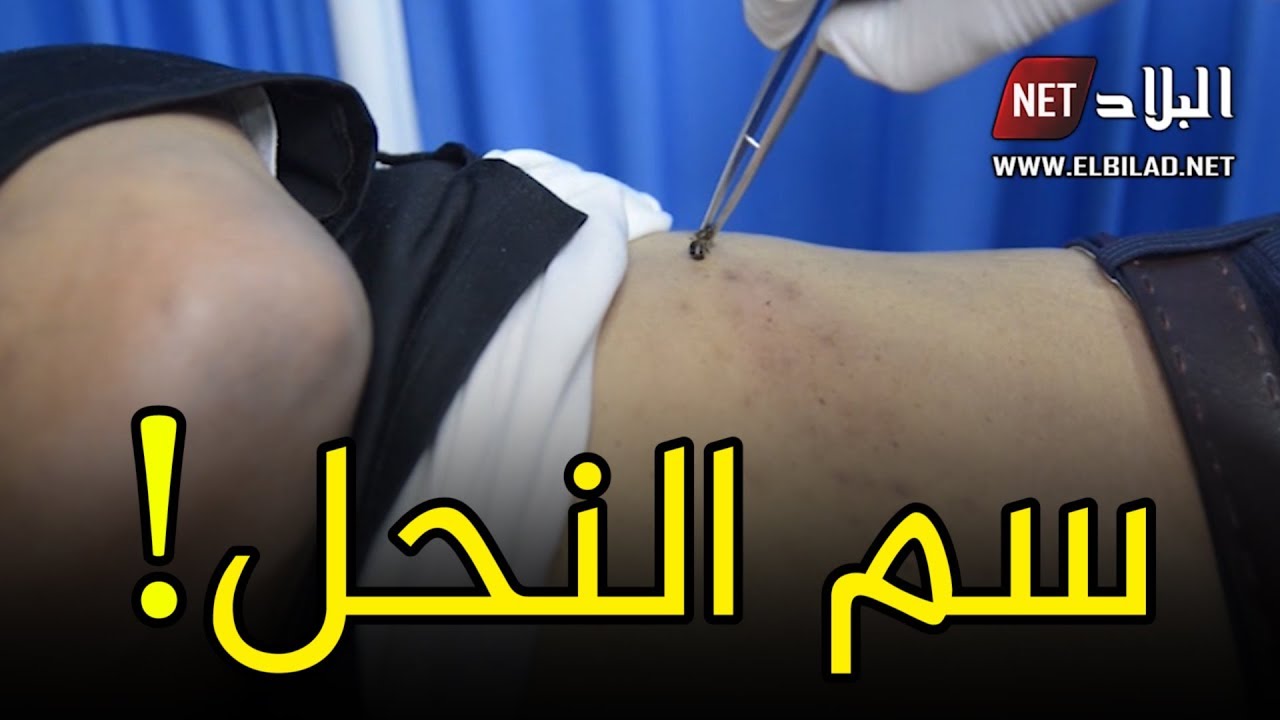 بشار: التداوي بسم النحل لعلاج الأمراض المزمنة