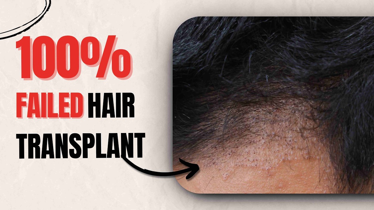 Watch Why His Hair Transplant Failed With This Side Effects or Mistake? | RQC Clinic | India