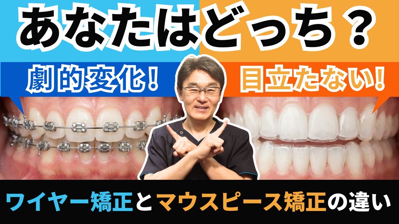 【徹底比較】マウスピース矯正とワイヤー矯正の違いは？費用・期間・見た目のなど、徹底比較します！