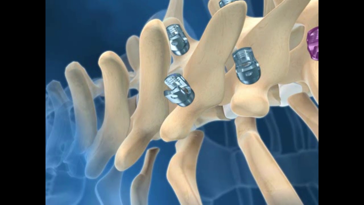 Scoliosis Correction-Animated Video