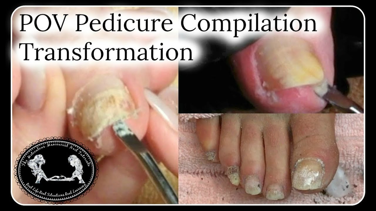 #4 POV Salon Pedicure Tutorial Toenail Transformation Compilation Big Toenail Cleaning ✔