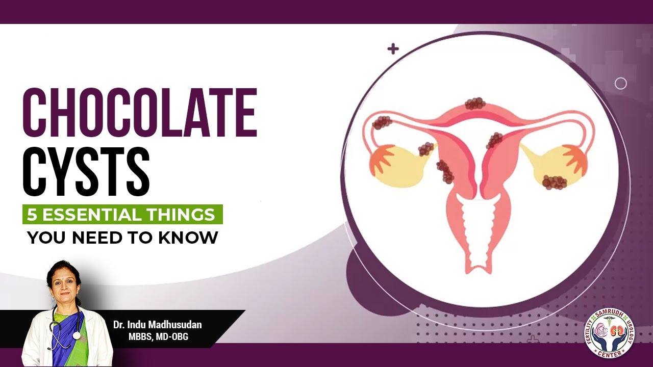 Chocolate Cysts : 5 Essential Things you need to Know!