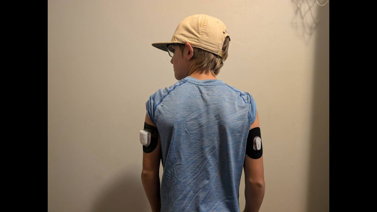Inserting Omnipod 5 Insulin Pump & Dexcom G6 in Arms of 10 Year Old for Type 1 Diabetes