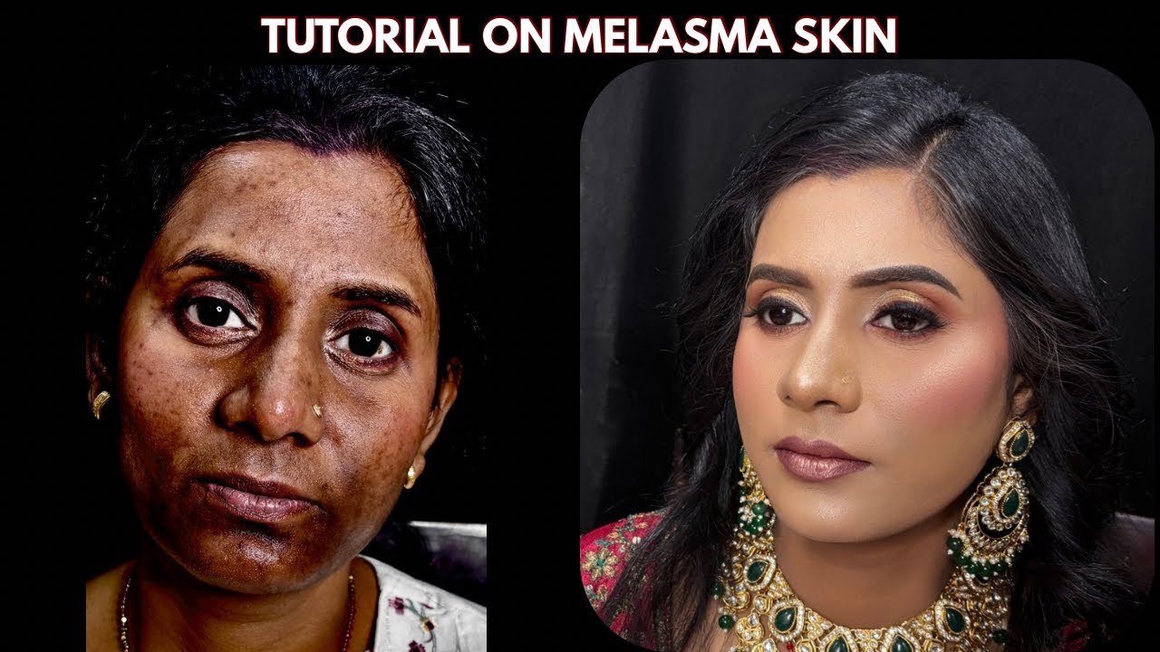 How to Cover Melasma Naturally | Pigmentation-Safe Makeup Tutorial