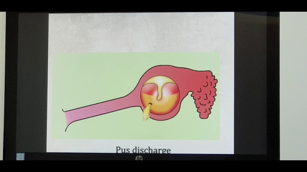 Chronic otitis media - Safe type Part 1 (Tamil) Patient teaching programme
