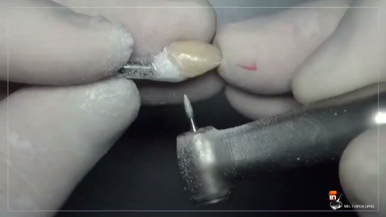 Provisórios sobre implantes - Resina Acrílica