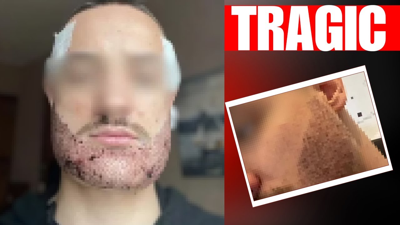 Bad Hair Transplant Ends In Tragedy