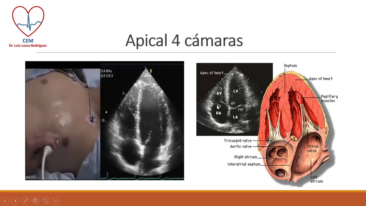 Ecocardiografía, imagen apical 4 camaras