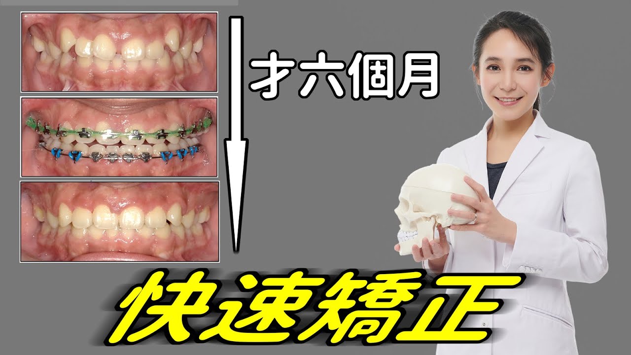 一年內完成的快速矯正，LH矯正、Fast Braces，可以改嘴凸和咬合不正嗎？｜林榆芩醫師