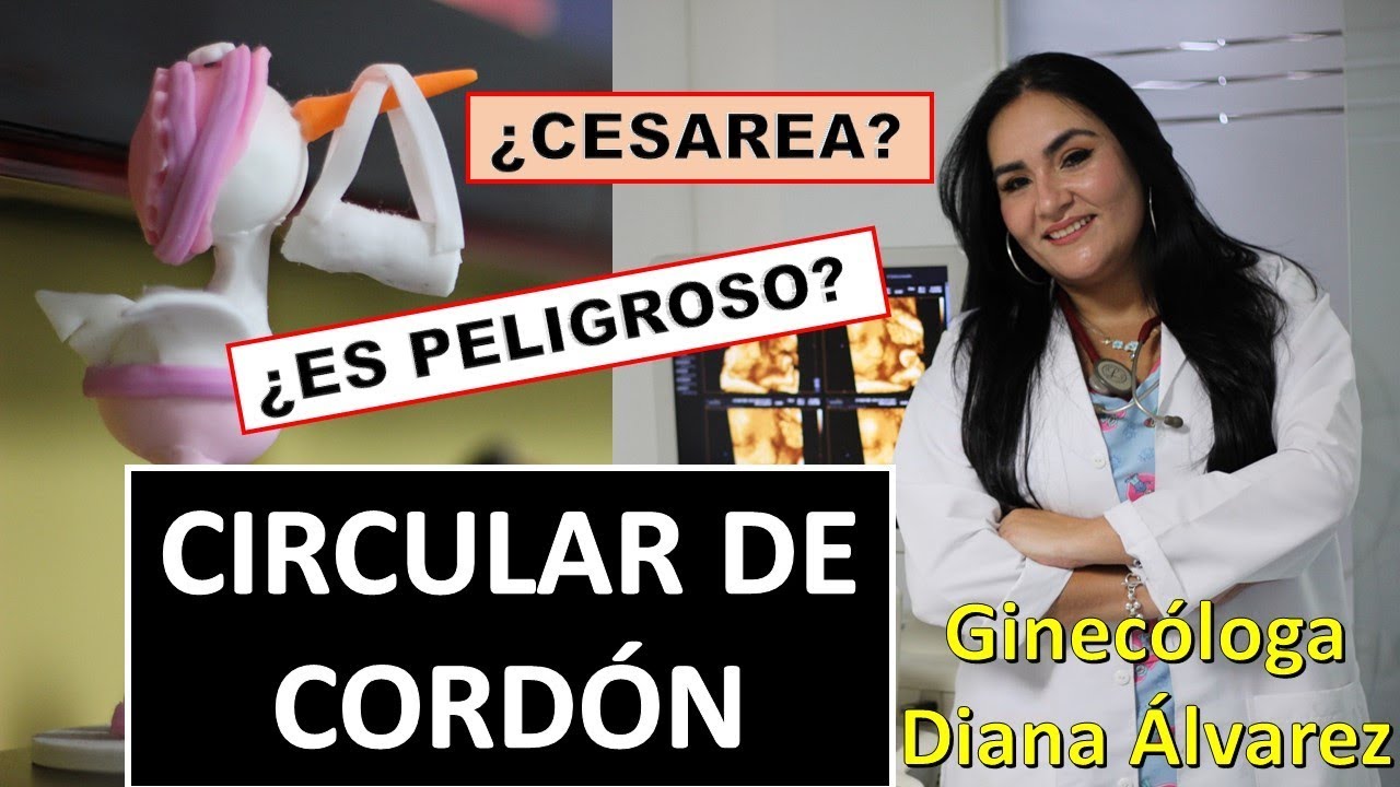 CIRCULAR DE CORDON, POR GINECOLOGA DIANA ALVAREZ