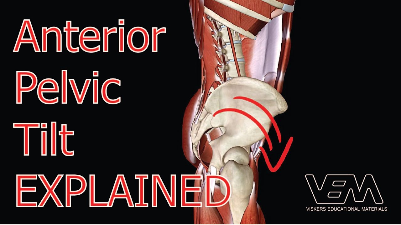Anterior Pelvic Tilt