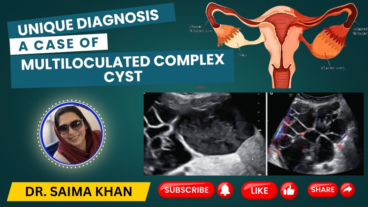 Dr Saimakhan EXPOSES the Shocking Truth About Complex Cysts @Dr.Saimakhan