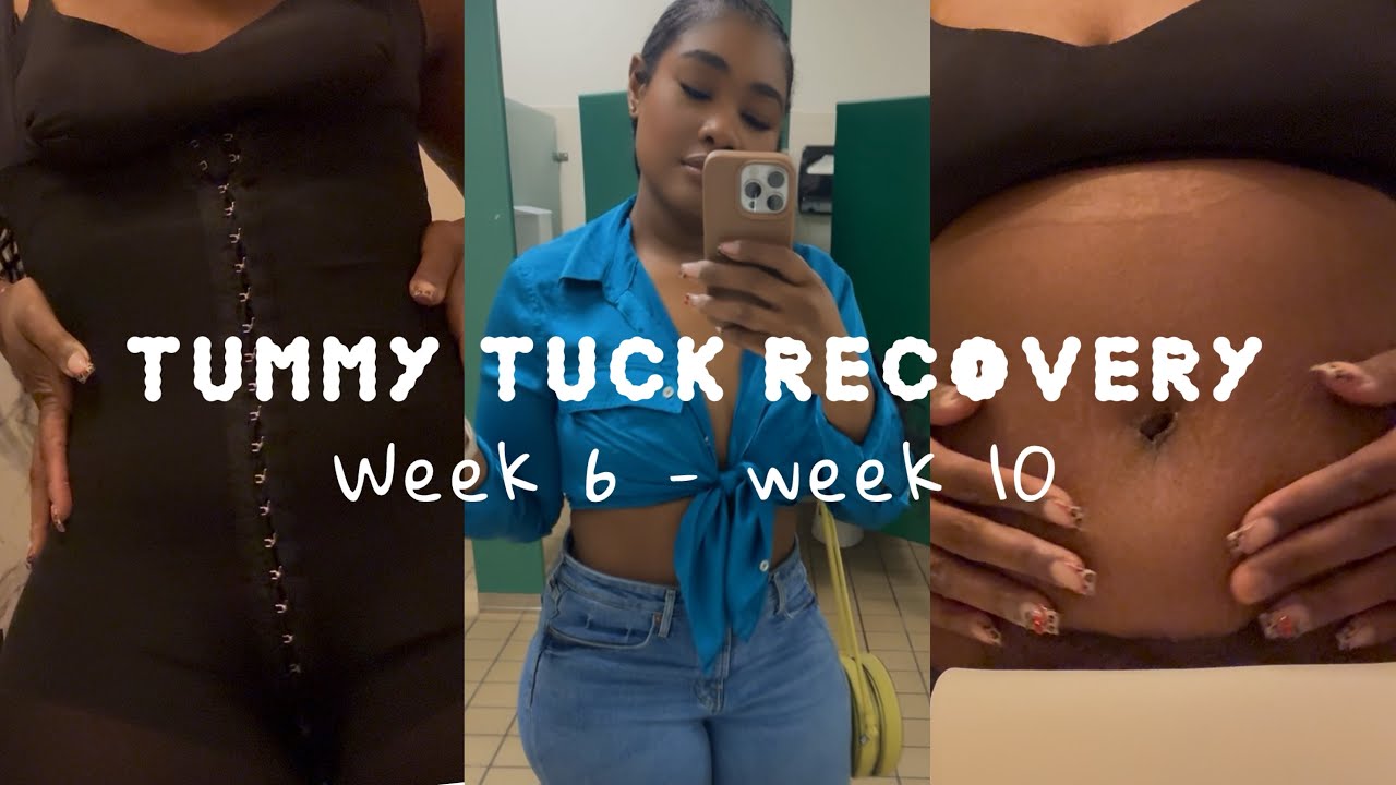 Addressing some things : Tummy Tuck Recovery