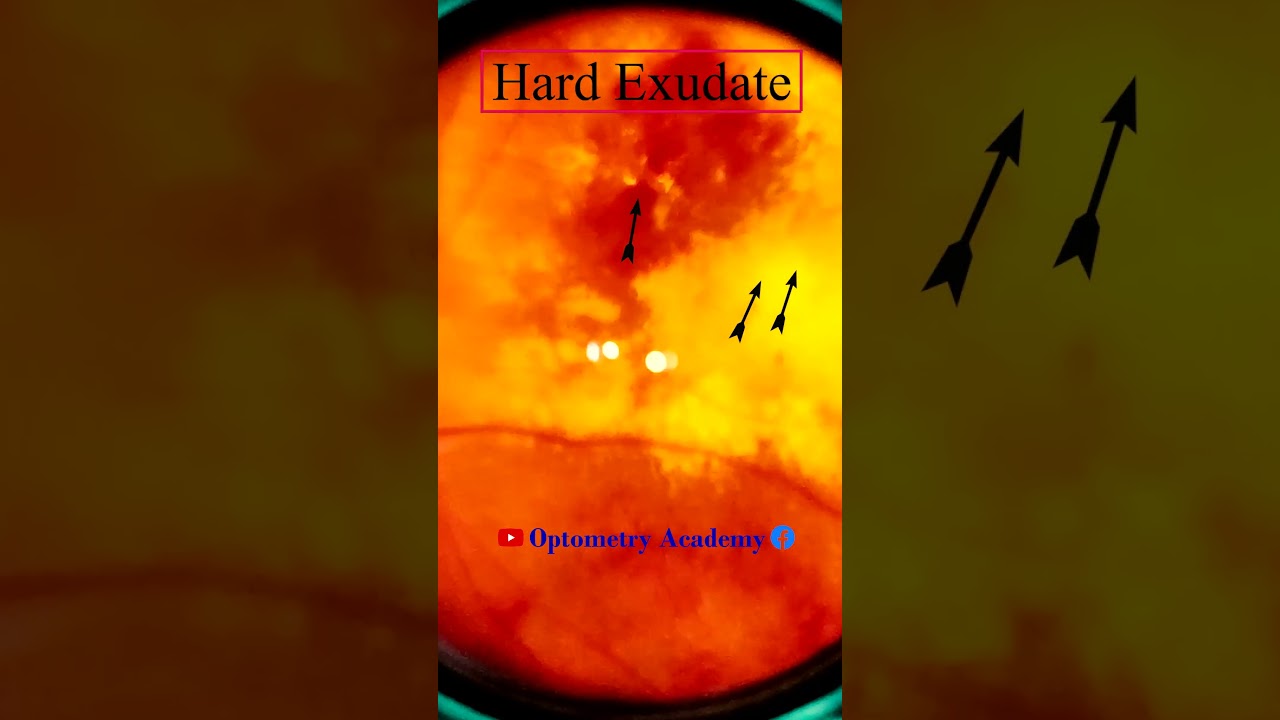 Diabetic retinopathy | Hemorrhages | Hard exudates | Fundus | Short Video 187
