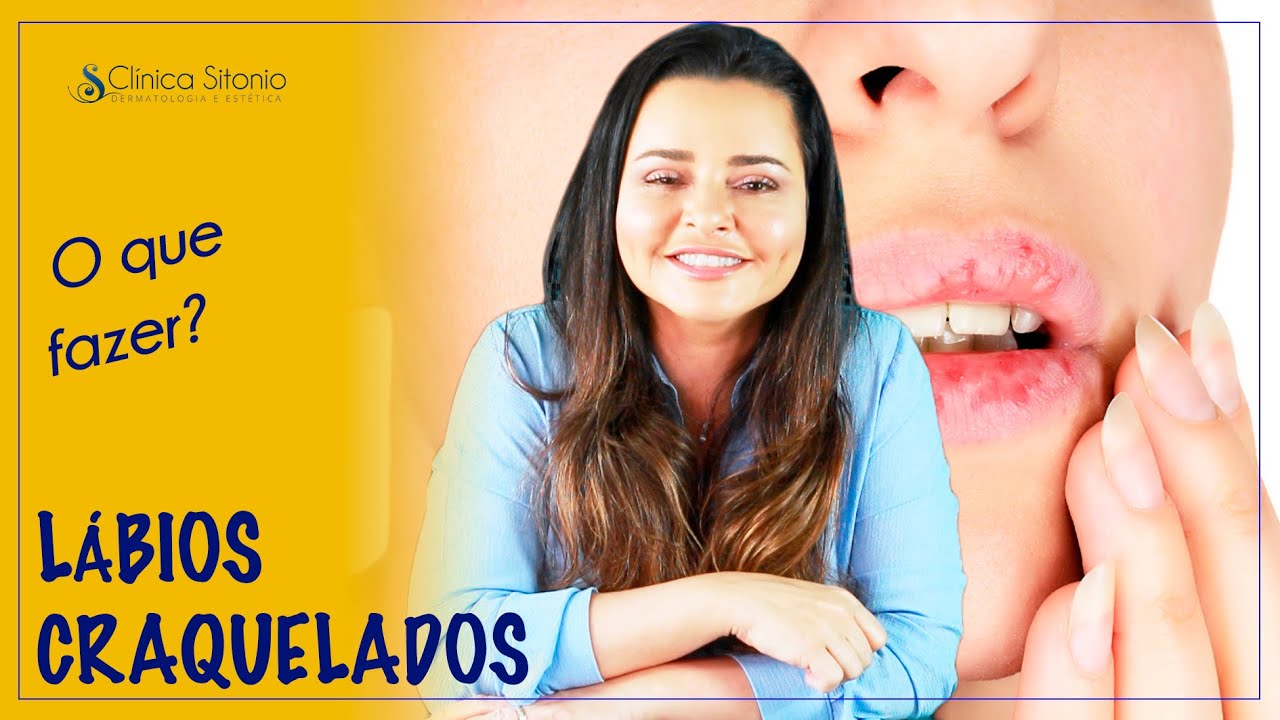 L&aacute;bios ressecados: o que fazer? Dra. Renata Sitonio