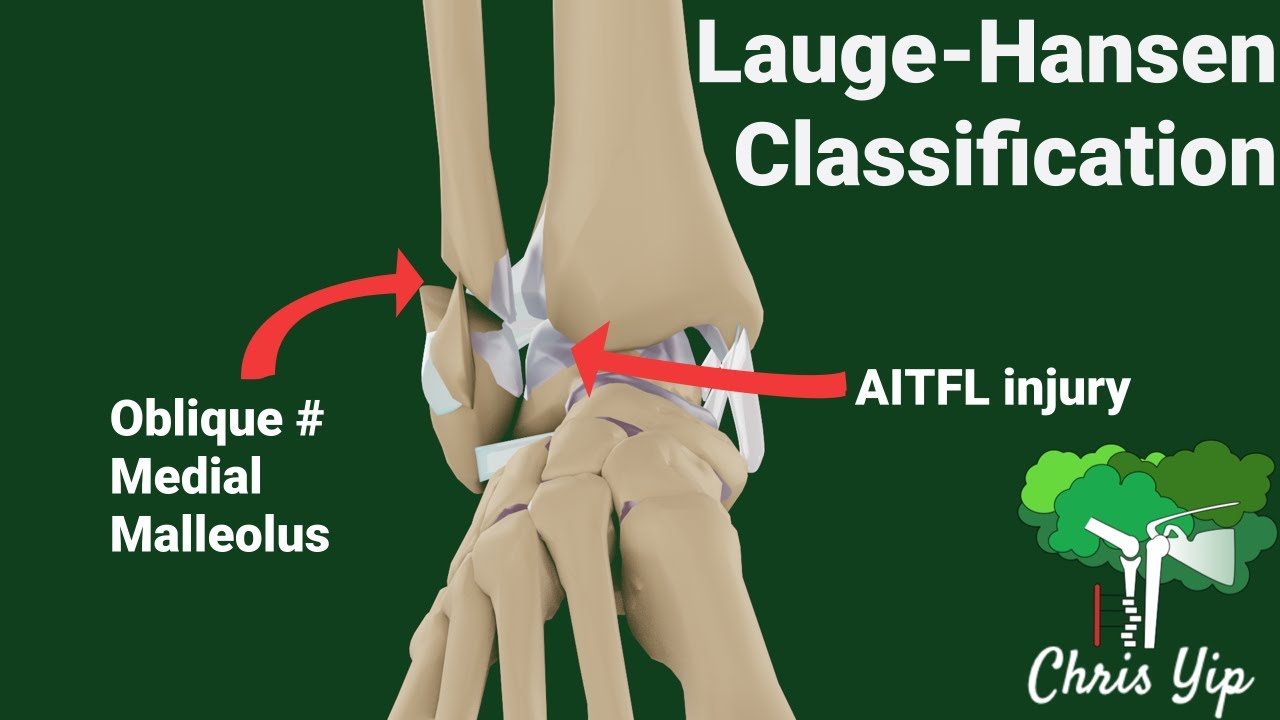 Lauge-Hansen classification for Ankle Fractures (Animated)