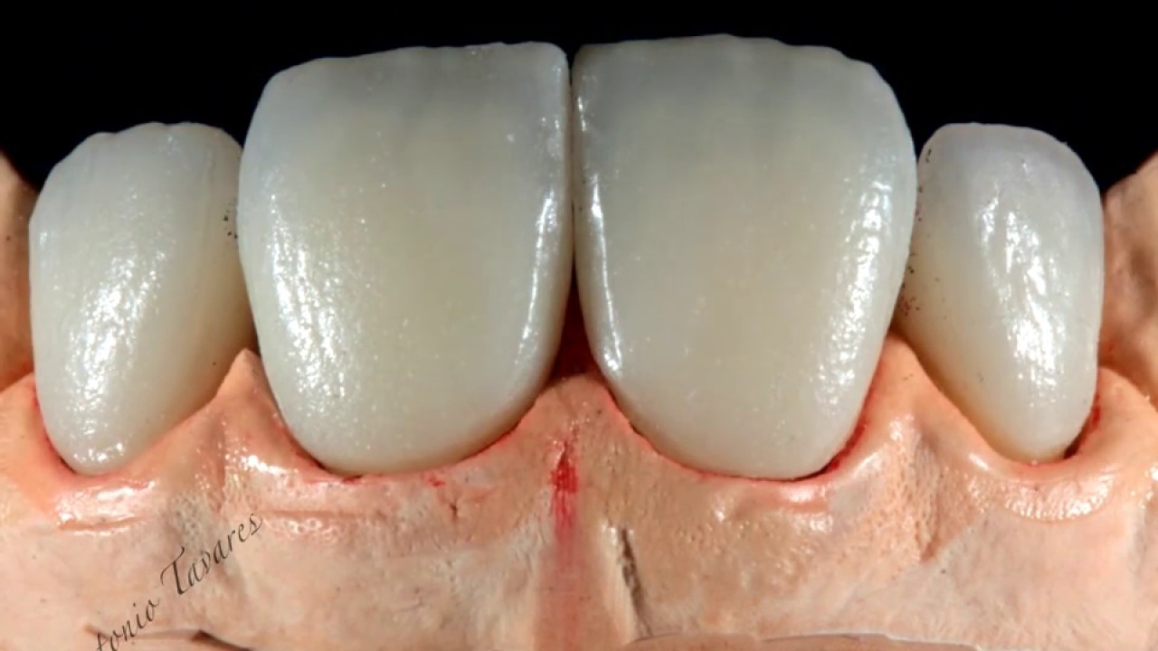 Faceta Ceramica e Coroa E.max Ivoclar.mov