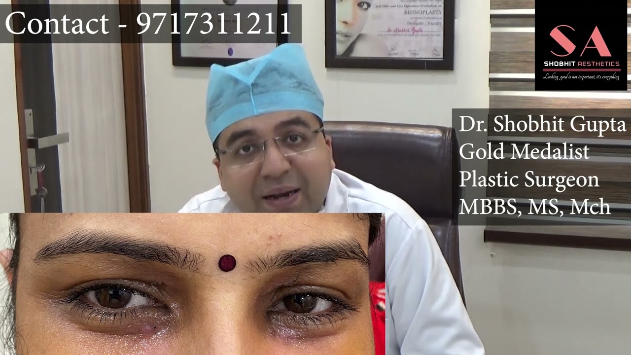 What is Xanthelasma Removal Treatment | Dr. Shobhit Gupta Xanthelasma Laser Removal Before and After