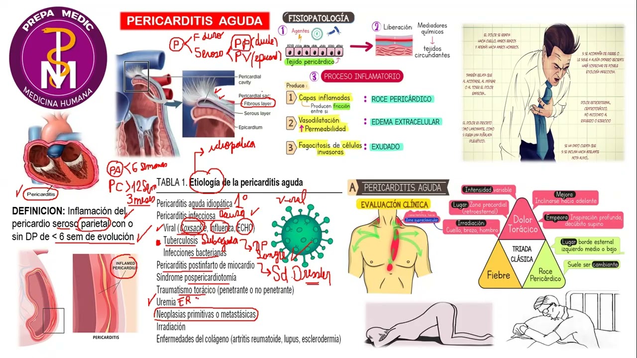 PERICARDITIS AGUDA // LAS FIJAS 2025