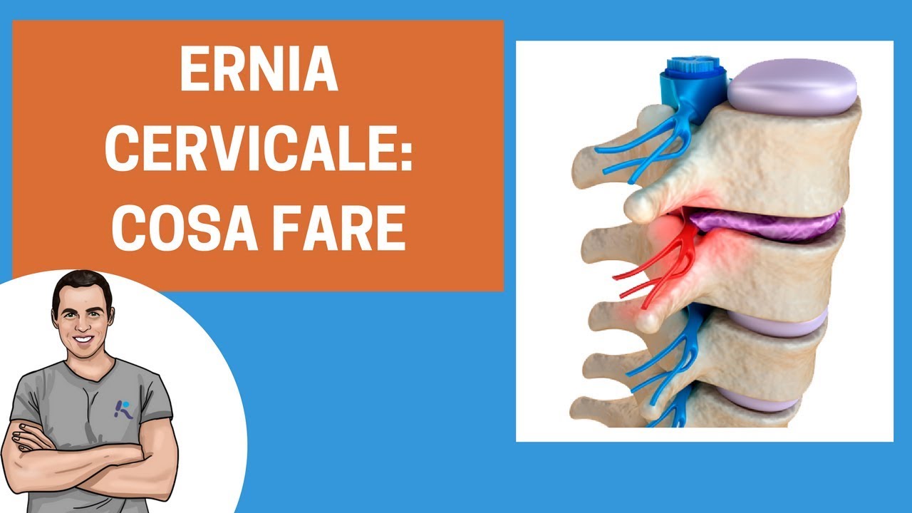 Ernia cervicale: guida ai consigli e agli esercizi
