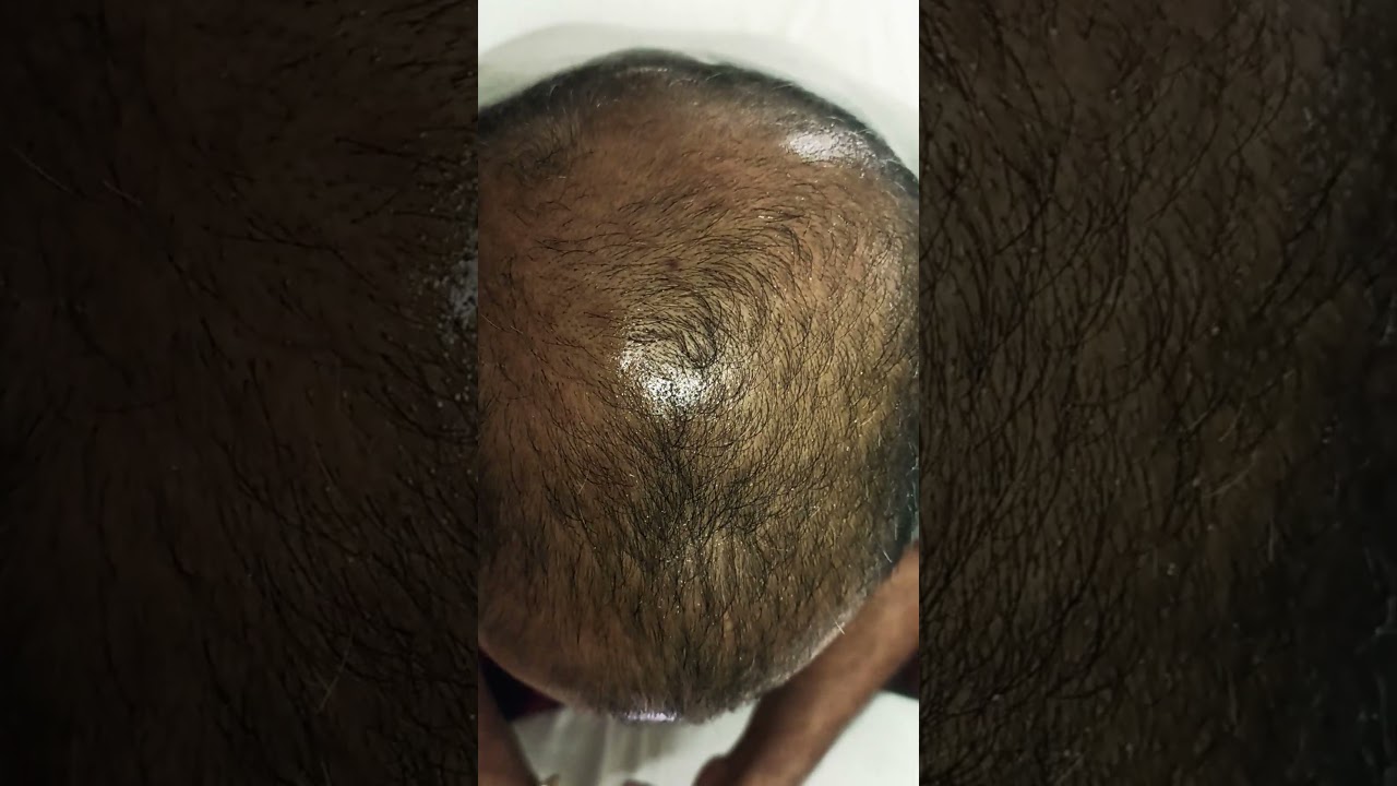 PRP Treatment Hair Regrowth results in two months