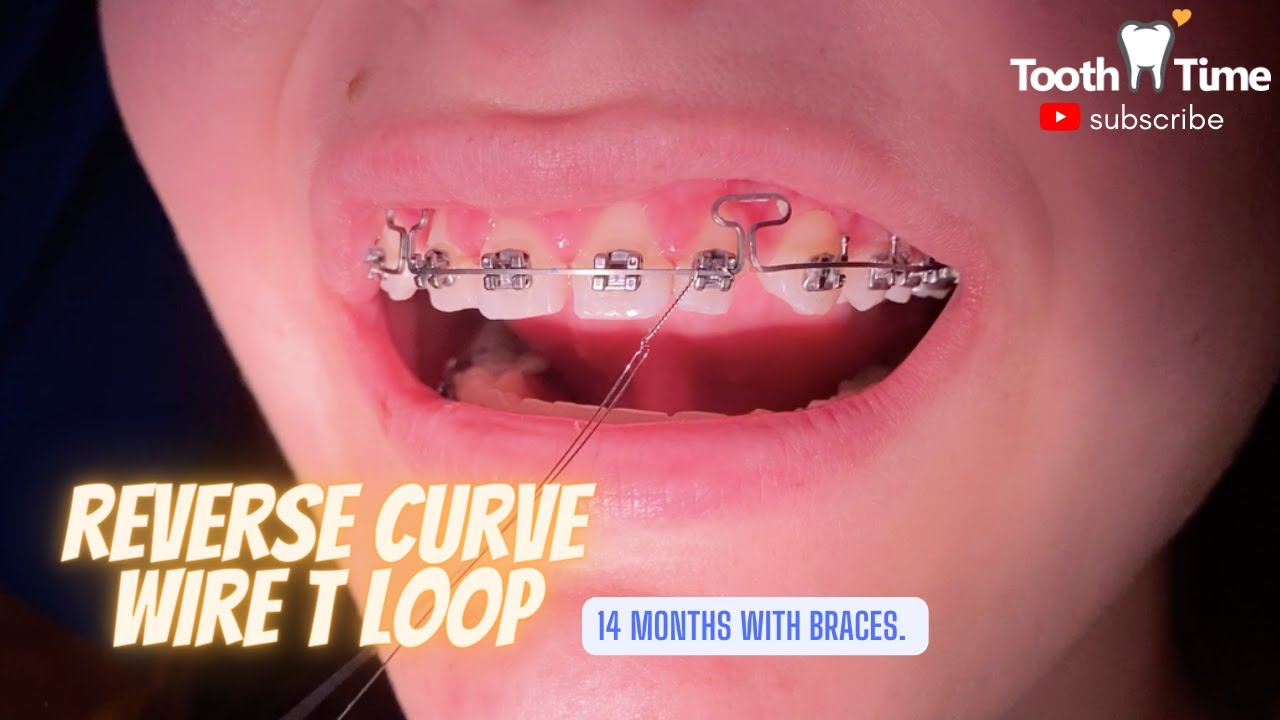 Что делает дуга с обратным изгибом для брекетов? Стоматология Tooth Time Family, Нью-Браунфелс, Т...