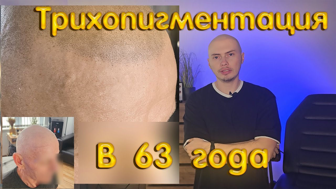 Трихопигментация в 63 года #трихопигментация #scalpmicropigmentation #облысение #пересадкаволос