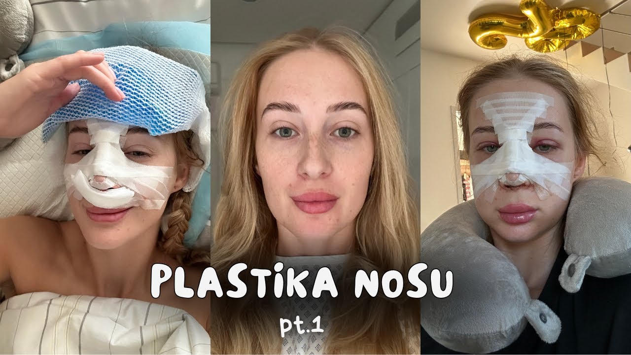 &Scaron;la jsem na septorhinoplastiku I operace + hojen&iacute;