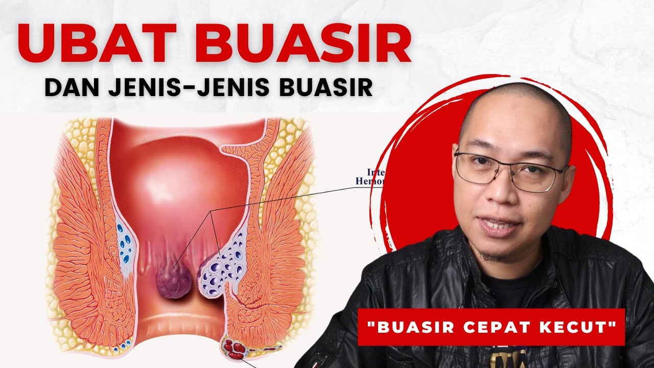 Ubat Buasir (Hemorrhoid) Jenis Buasir Dan Testimoni  Berjaya