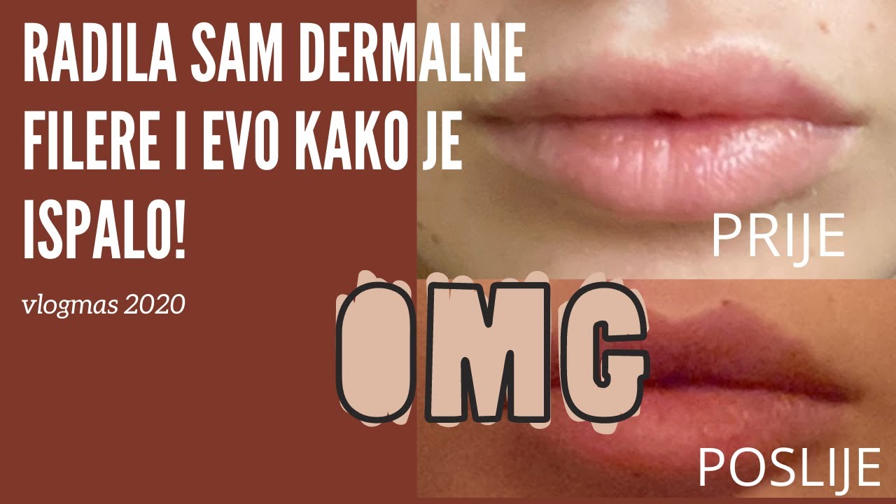 RADILA SAM DERMALNE FILERE I EVO KAKO JE ISPALO | VLOGMAS 2020 | VLOGMAS 2020