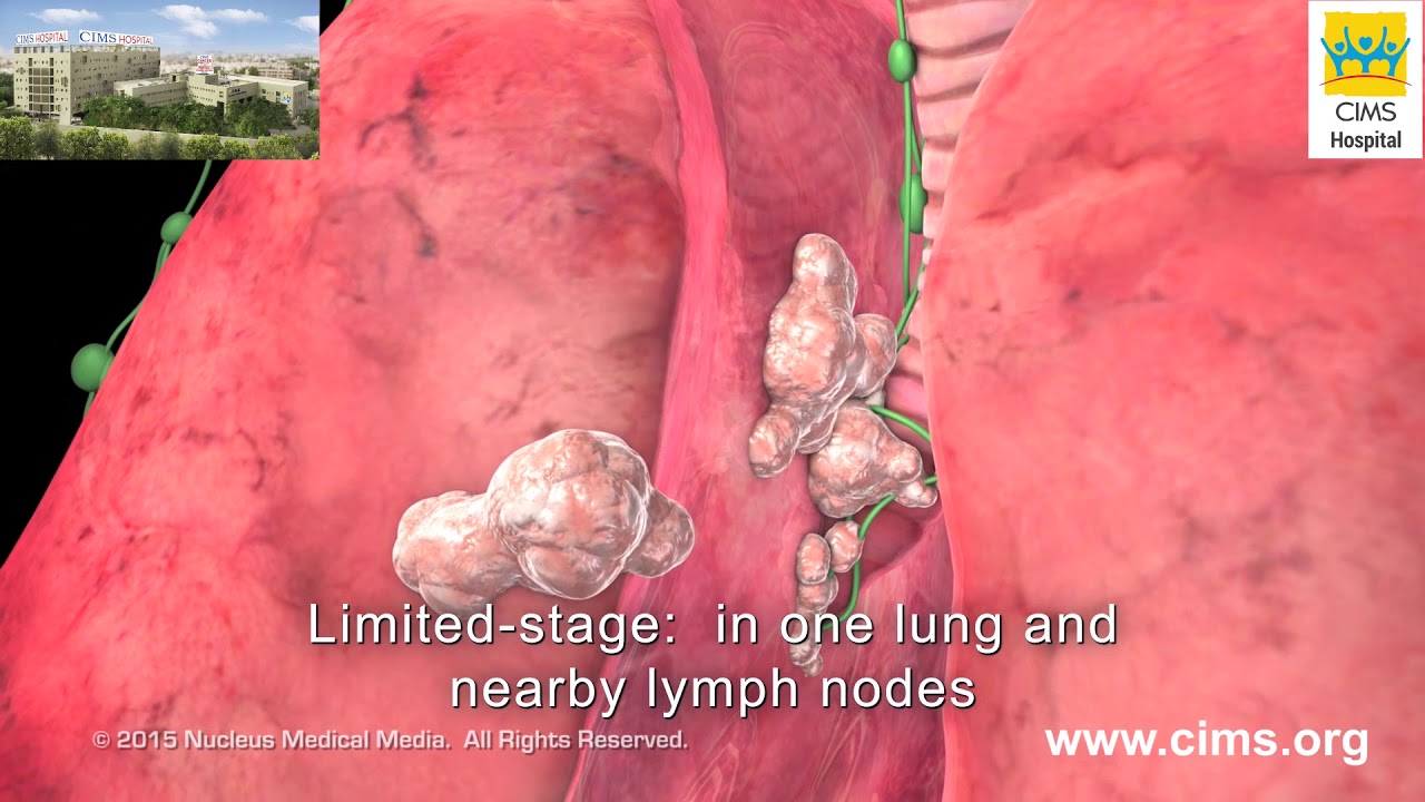 Small Cell Lung Cancer Staging &ndash; CIMS Hospital