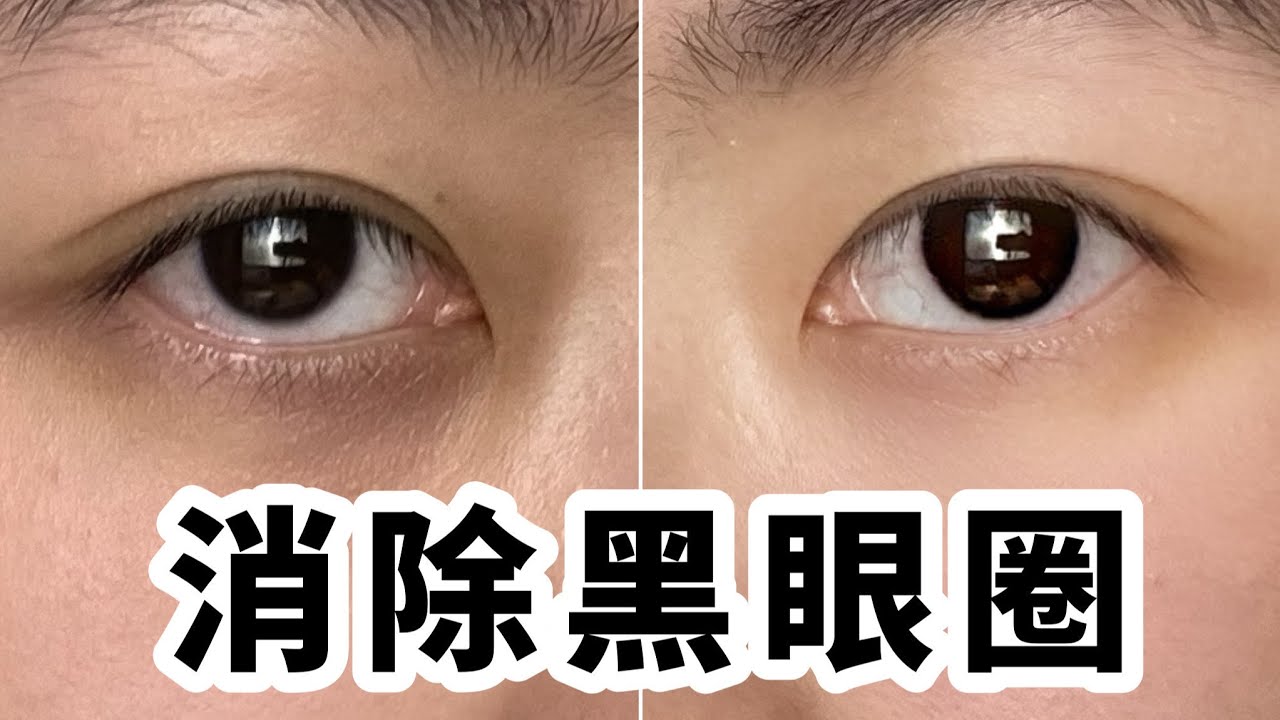 黑眼圈怪熬夜？找准原因，教你3分鐘告別黑眼圈！