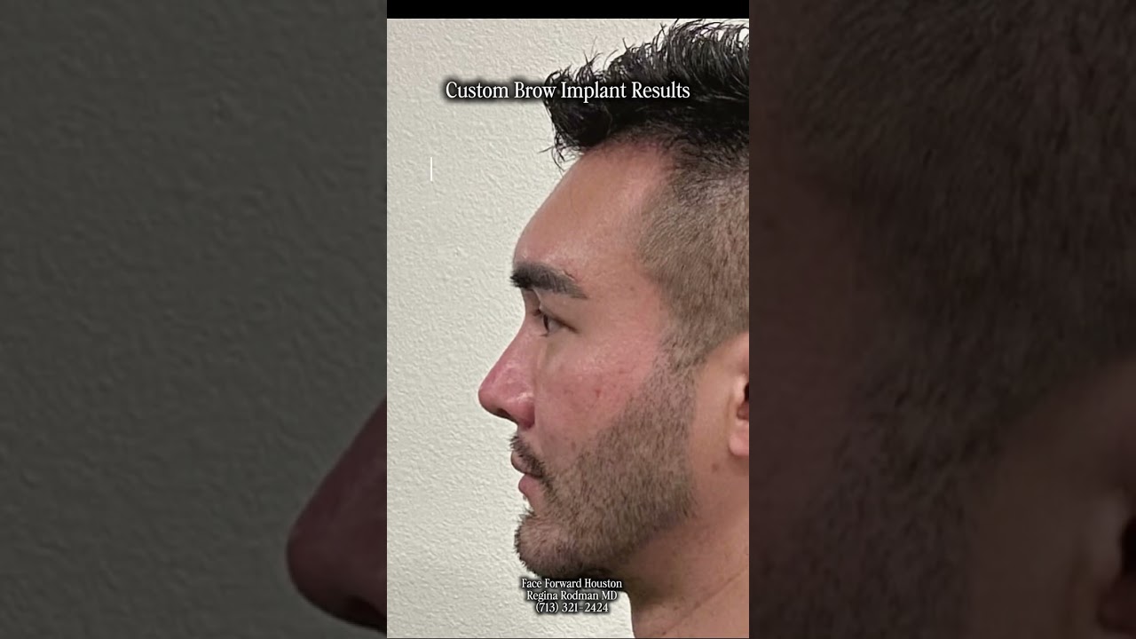 Brow Bone Augmentation| Facial Implants| Before and After