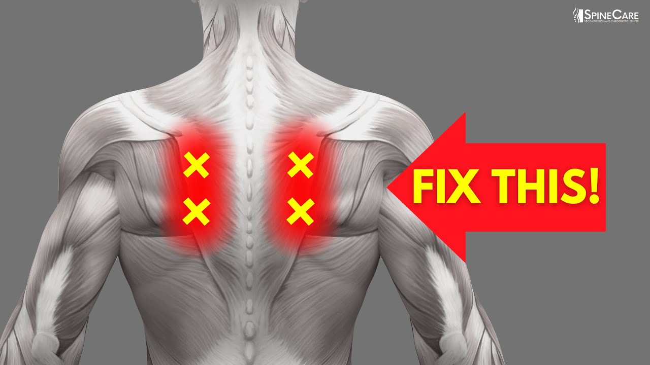 How to Fix Nerve Pain in the Shoulder Blades