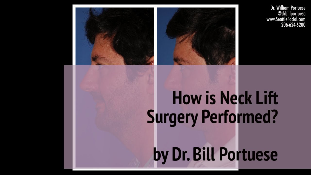 How is Neck Lift Surgery Performed? (Turkey Neck) by Dr. William Portuese  👨&zwj;⚕️ | Seattle WA