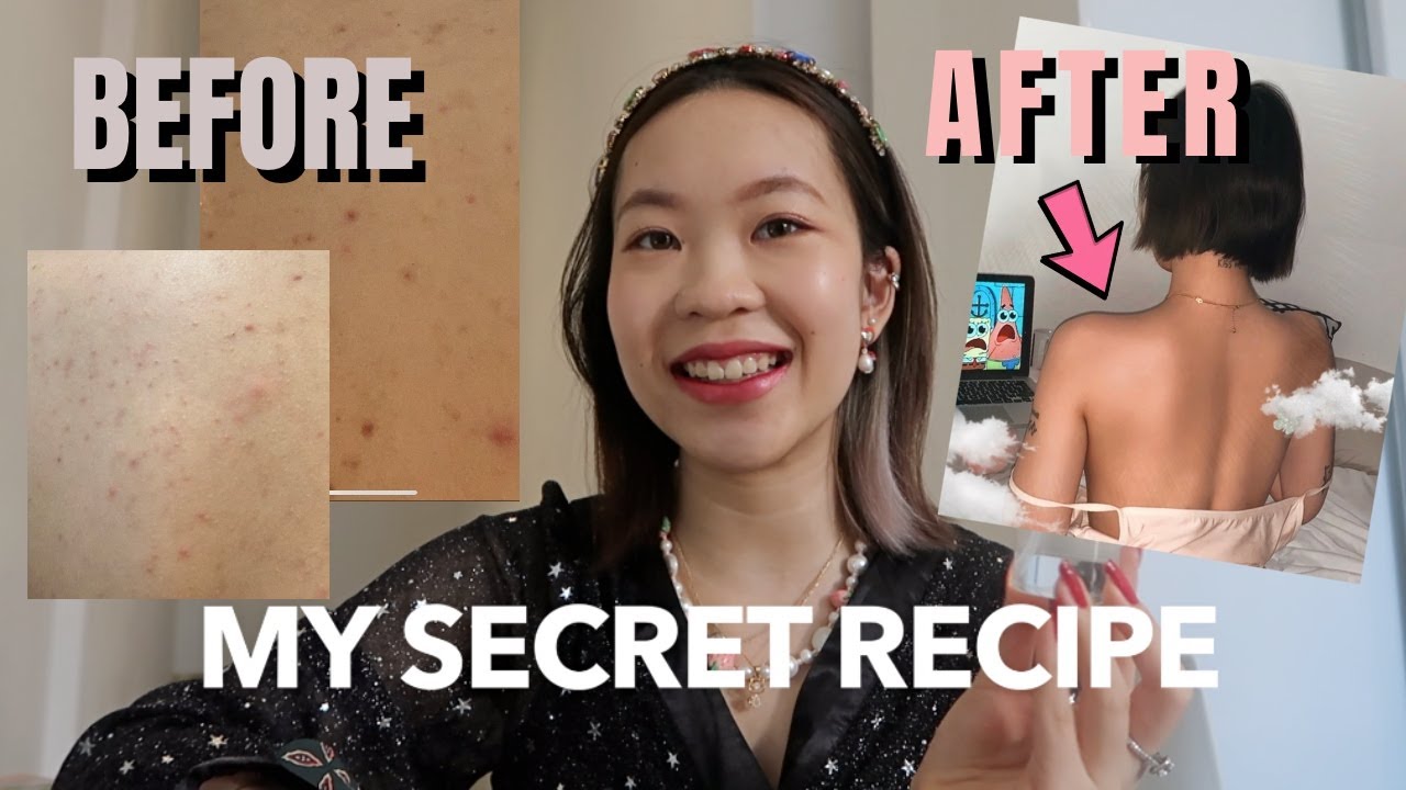 HOW I CURED MY BACK ACNE (Before/After Photos) | Euodias